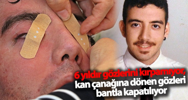 6 yıldır gözlerini kırpamıyor, kan çanağına dönen gözleri bantla kapatılıyor